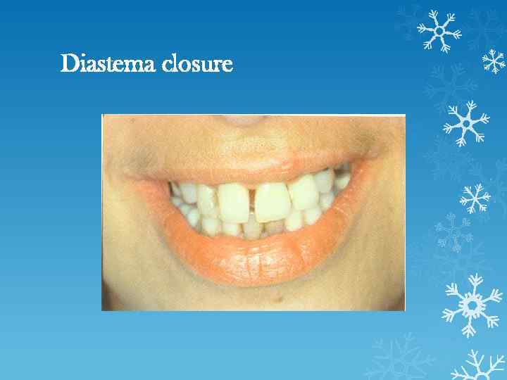 Diastema closure 