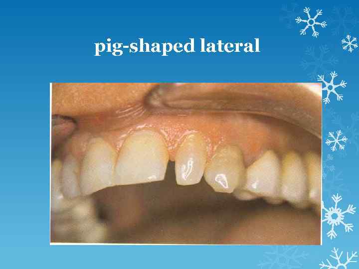 pig-shaped lateral 