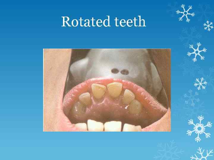 Rotated teeth 