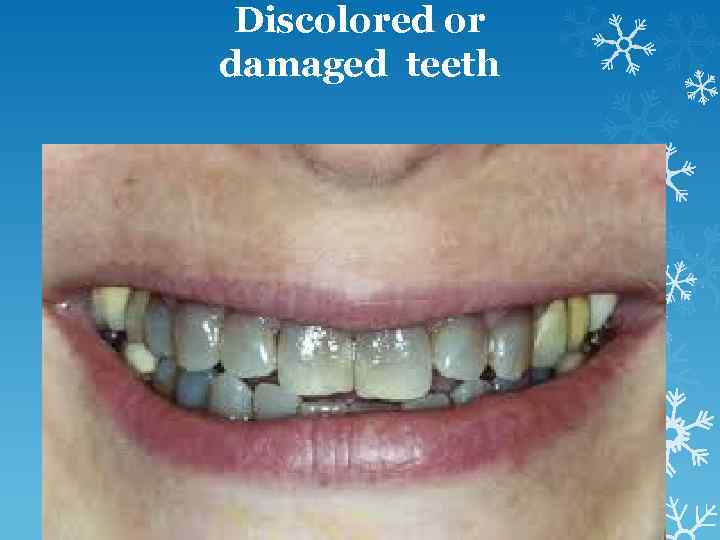 Discolored or damaged teeth 
