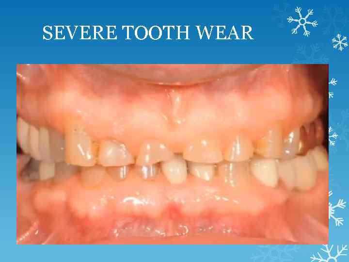 SEVERE TOOTH WEAR 