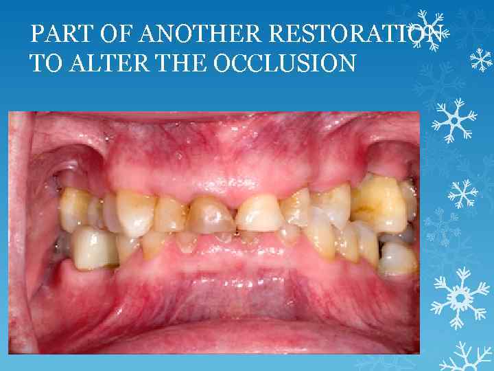 PART OF ANOTHER RESTORATION TO ALTER THE OCCLUSION 