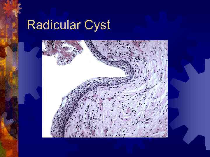 Radicular Cyst 