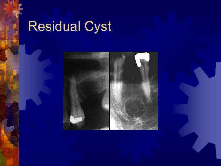 Residual Cyst 