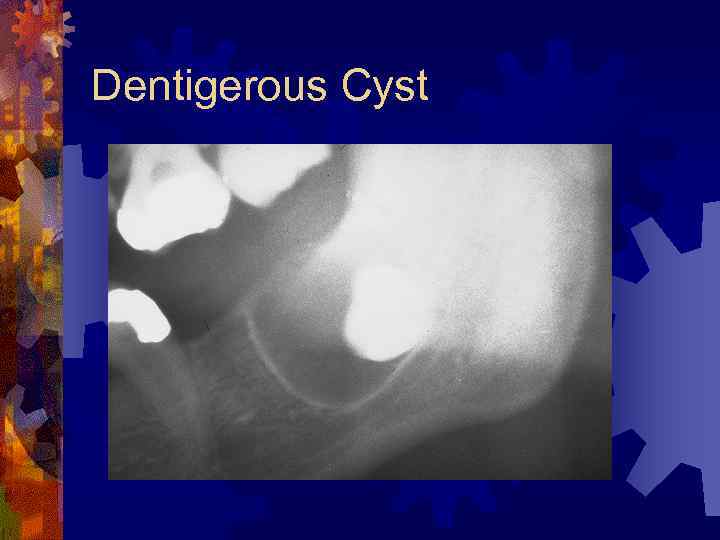 Dentigerous Cyst 