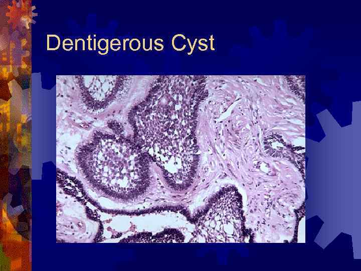 Dentigerous Cyst 