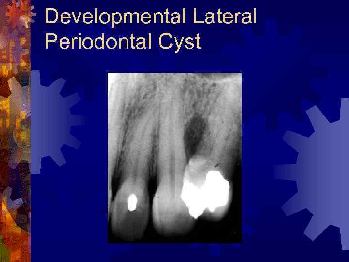 Developmental Lateral Periodontal Cyst 