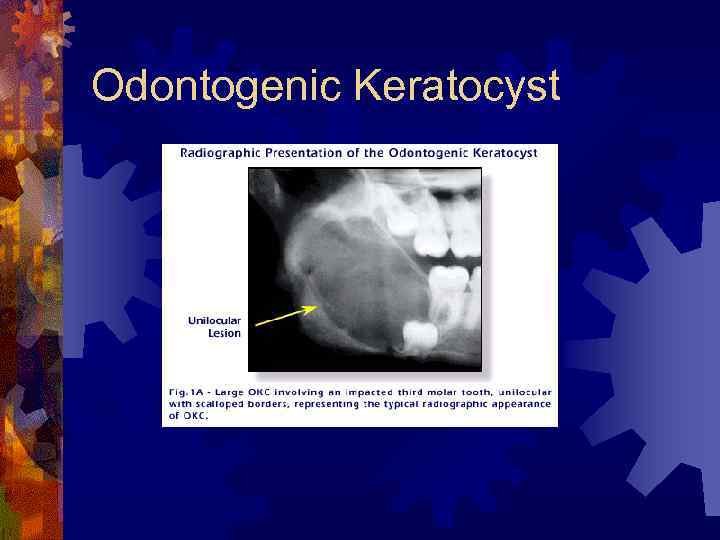 Odontogenic Keratocyst 