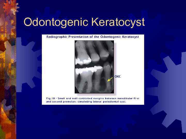 Odontogenic Keratocyst 