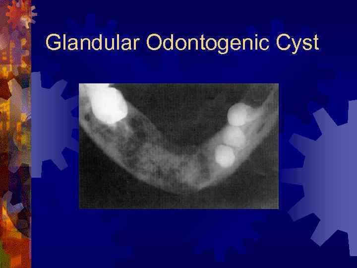 Glandular Odontogenic Cyst 