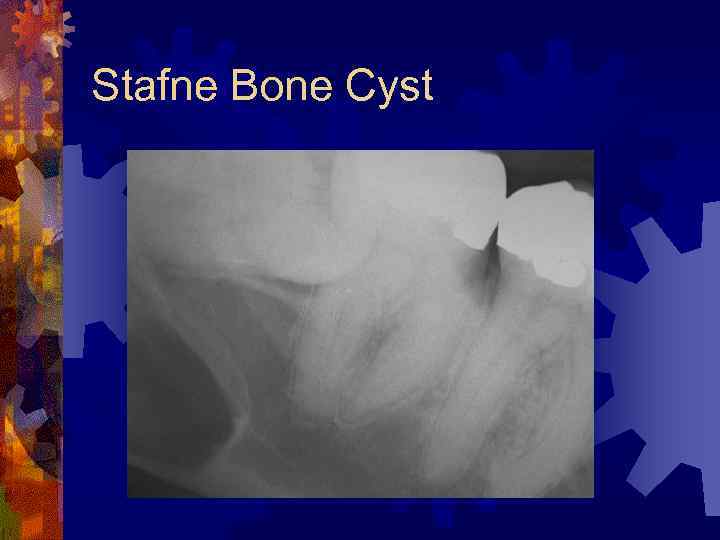 Stafne Bone Cyst 