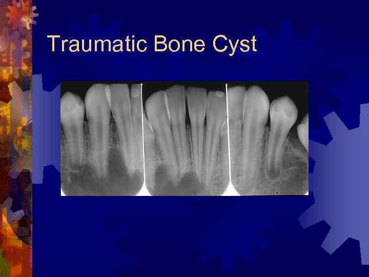 Traumatic Bone Cyst 