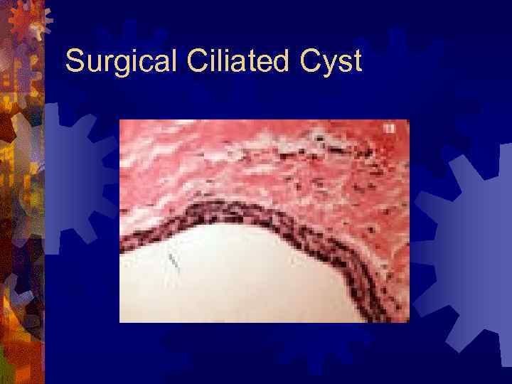 Surgical Ciliated Cyst 