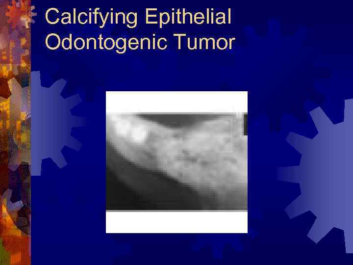 Calcifying Epithelial Odontogenic Tumor 