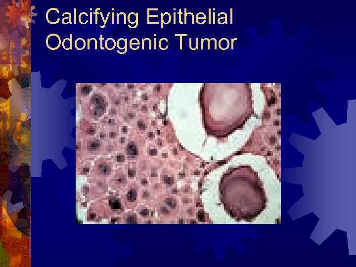 Calcifying Epithelial Odontogenic Tumor 