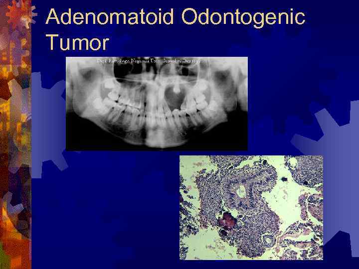 Adenomatoid Odontogenic Tumor 