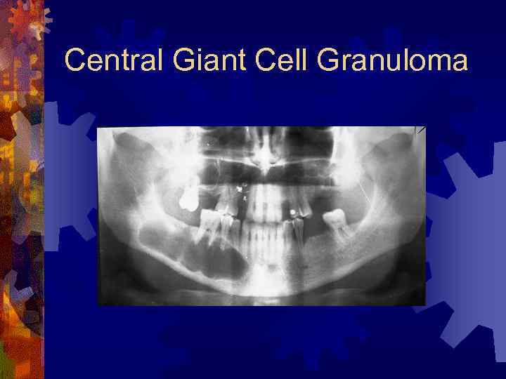 Central Giant Cell Granuloma 