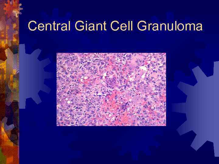 Central Giant Cell Granuloma 