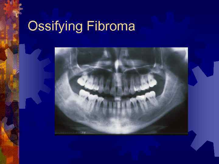Ossifying Fibroma 