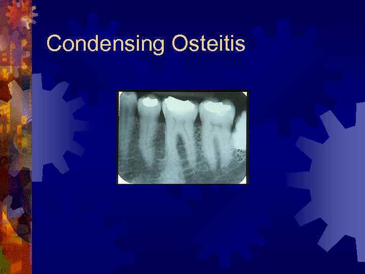 Condensing Osteitis 