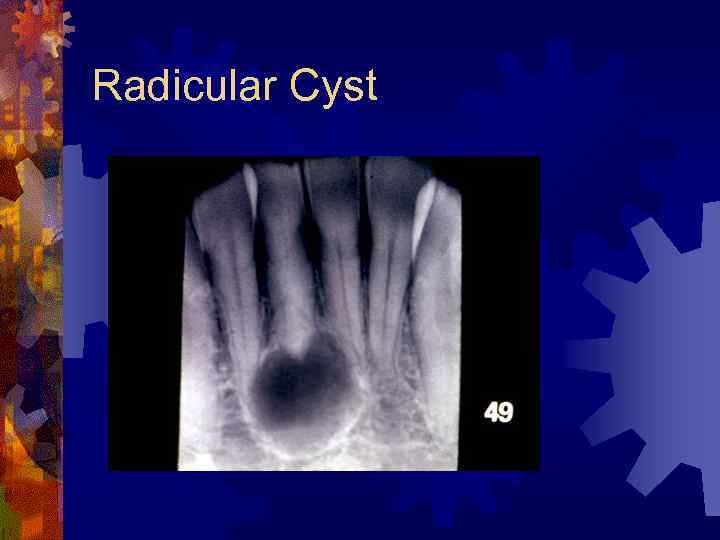 Radicular Cyst 