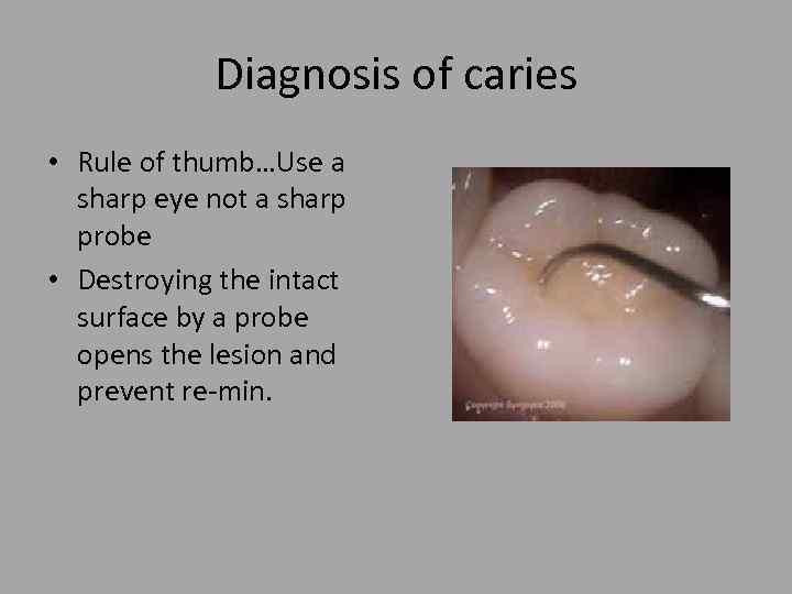 Diagnosis of caries • Rule of thumb…Use a sharp eye not a sharp probe