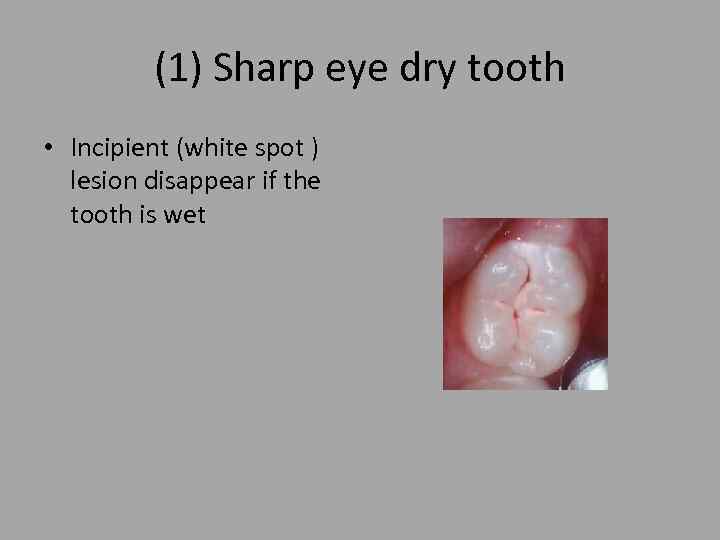 (1) Sharp eye dry tooth • Incipient (white spot ) lesion disappear if the