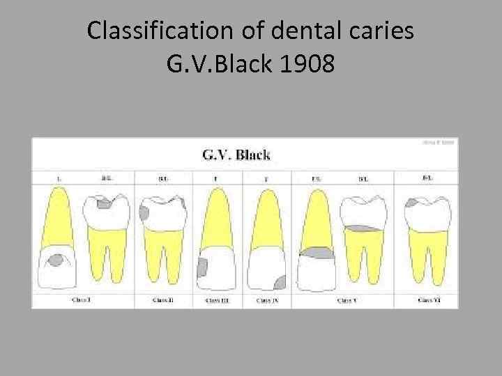 Classification of dental caries G. V. Black 1908 