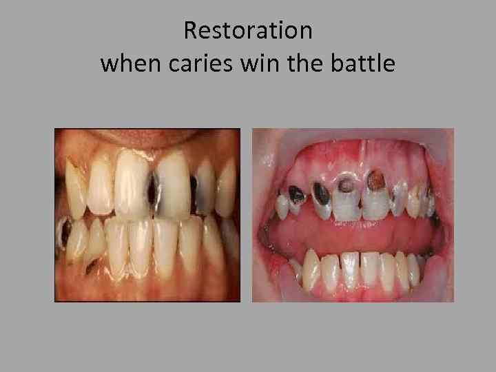 Restoration when caries win the battle 