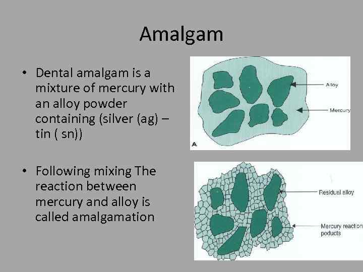 Amalgam • Dental amalgam is a mixture of mercury with an alloy powder containing