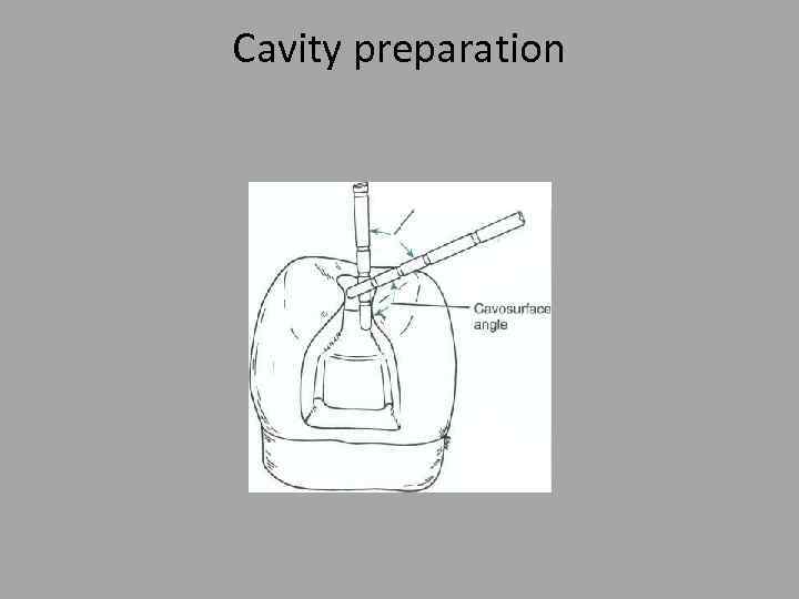 Cavity preparation 