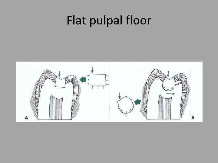 Flat pulpal floor 