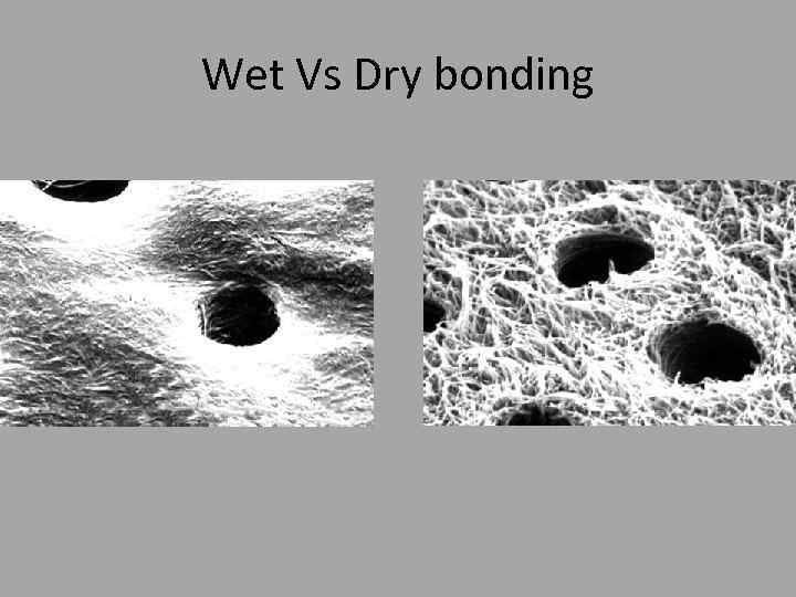 Wet Vs Dry bonding 