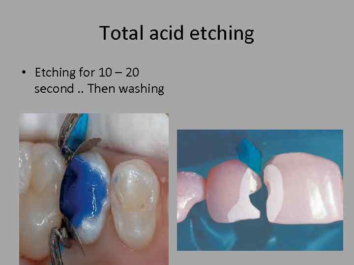 Total acid etching • Etching for 10 – 20 second. . Then washing 