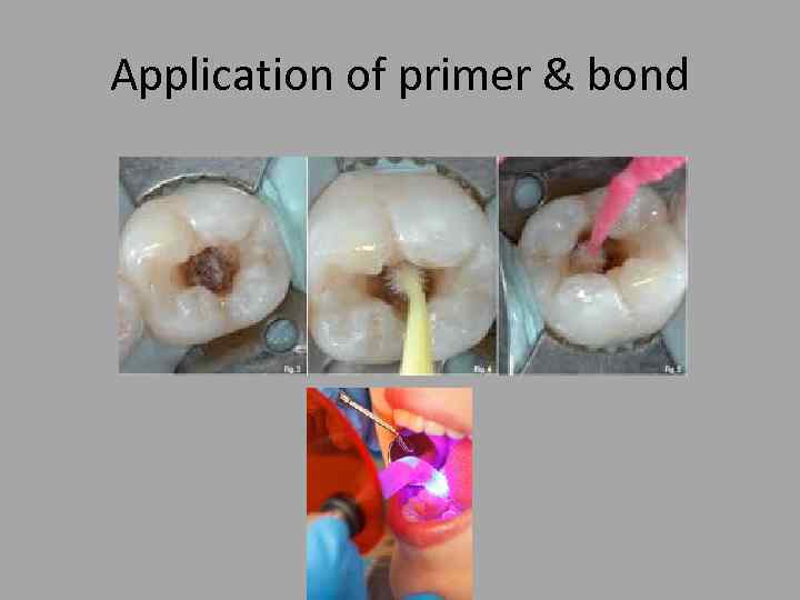 Application of primer & bond 