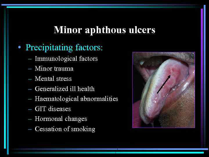 Minor aphthous ulcers • Precipitating factors: – – – – Immunological factors Minor trauma