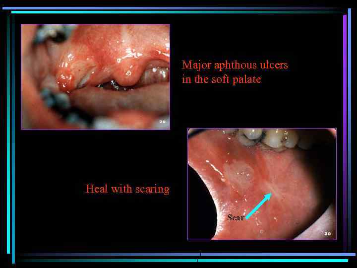 Major aphthous ulcers in the soft palate Heal with scaring Scar 