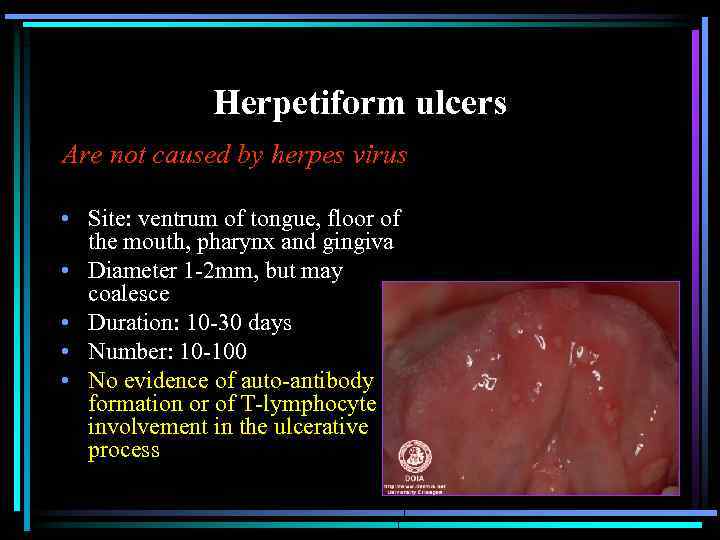 Herpetiform ulcers Are not caused by herpes virus • Site: ventrum of tongue, floor