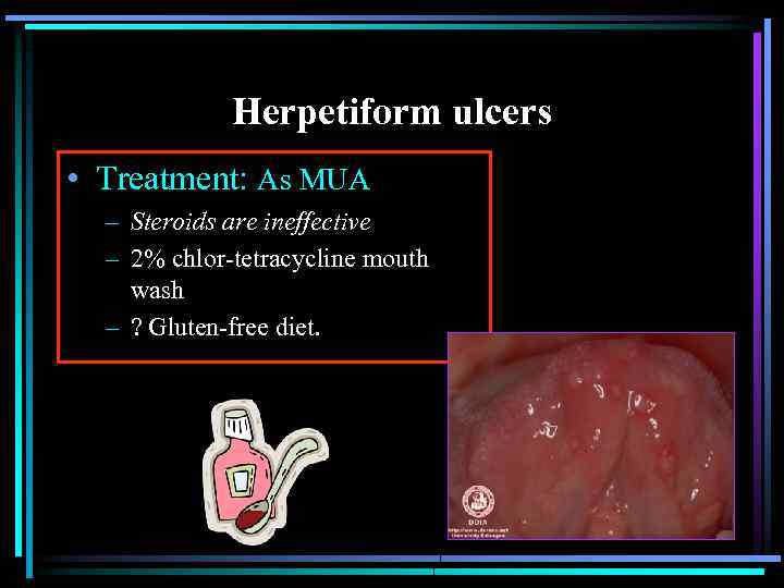 Herpetiform ulcers • Treatment: As MUA – Steroids are ineffective – 2% chlor-tetracycline mouth