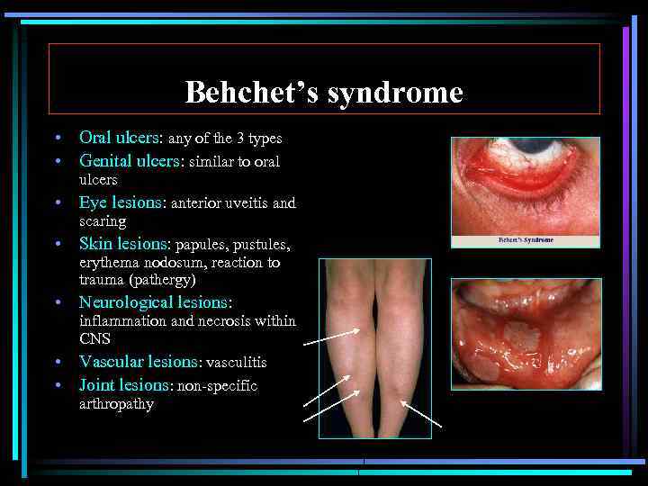 Behchet’s syndrome • Oral ulcers: any of the 3 types • Genital ulcers: similar