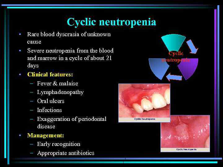 Cyclic neutropenia • Rare blood dyscrasia of unknown cause • Severe neutropenia from the