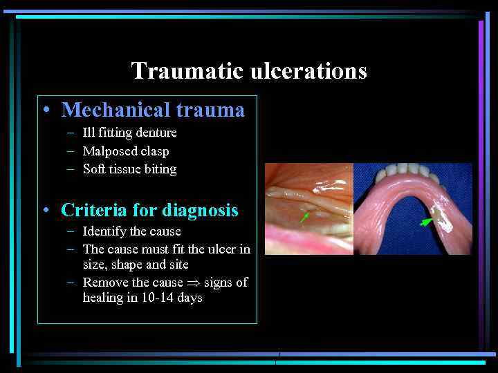 Traumatic ulcerations • Mechanical trauma – Ill fitting denture – Malposed clasp – Soft