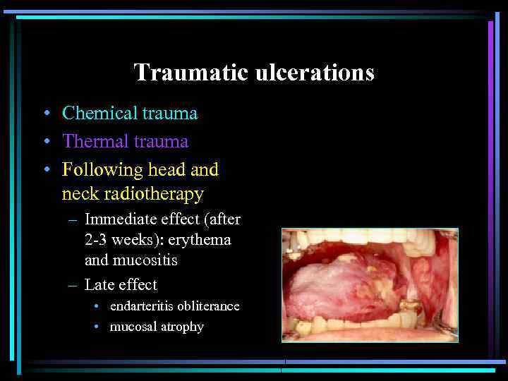 Traumatic ulcerations • Chemical trauma • Thermal trauma • Following head and neck radiotherapy