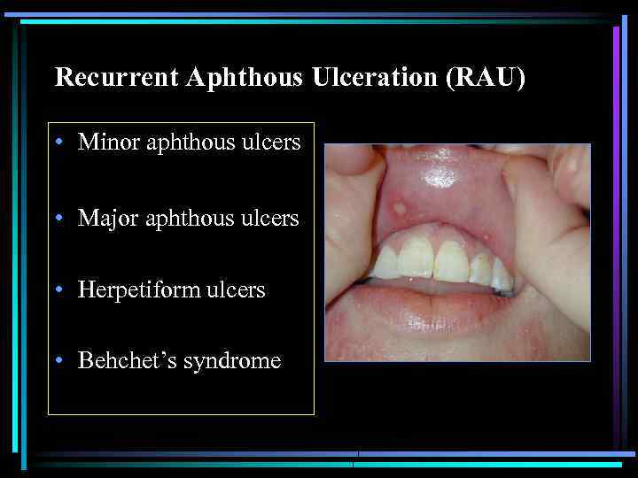 Recurrent Aphthous Ulceration (RAU) • Minor aphthous ulcers • Major aphthous ulcers • Herpetiform