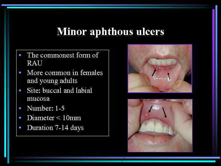 Minor aphthous ulcers • The commonest form of RAU • More common in females