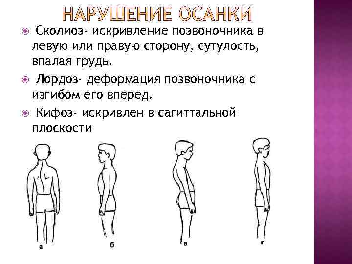 Рассмотрите рисунки 1 4 с изображением типов осанок человека как называют нарушение осанки 4