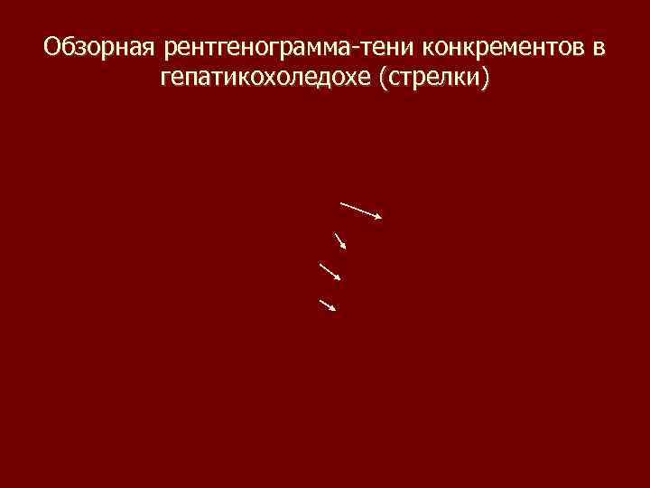 Обзорная рентгенограмма-тени конкрементов в гепатикохоледохе (стрелки) 