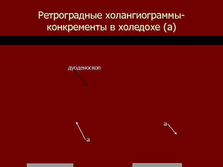 Ретроградные холангиограммыконкременты в холедохе (а) дуоденоскоп а а 