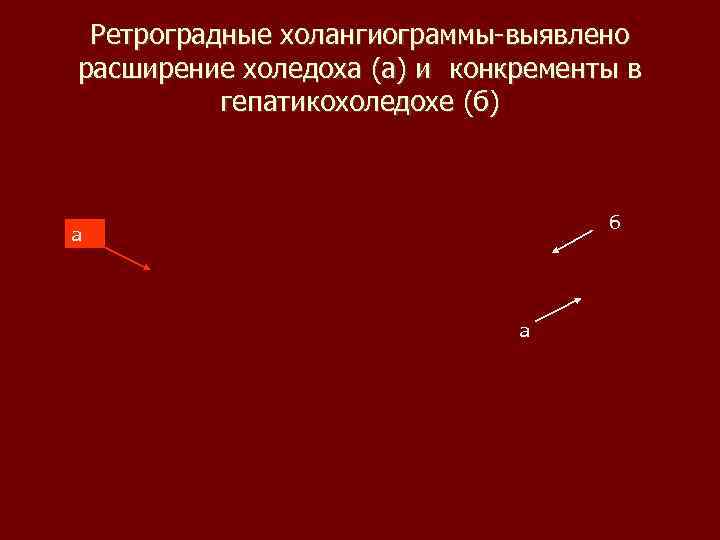 Ретроградные холангиограммы-выявлено расширение холедоха (а) и конкременты в гепатикохоледохе (б) б а а 