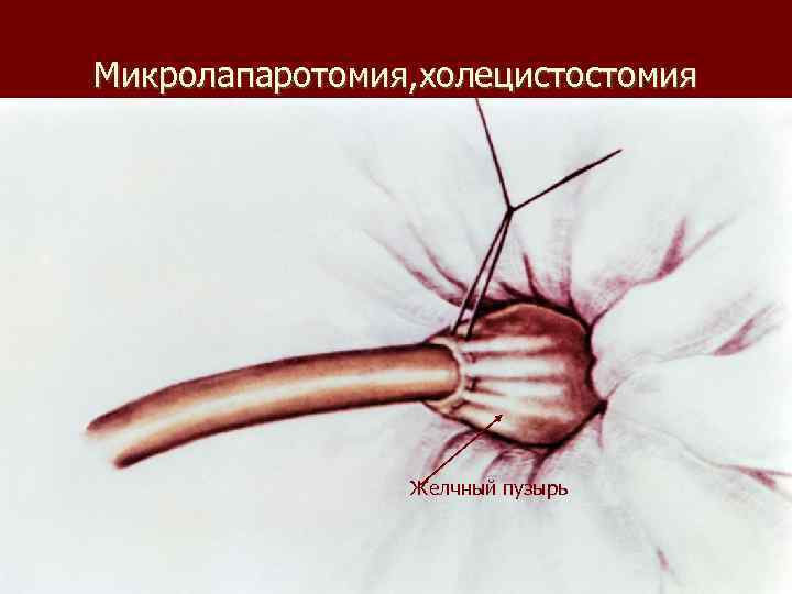 Микролапаротомия, холецистостомия Желчный пузырь 